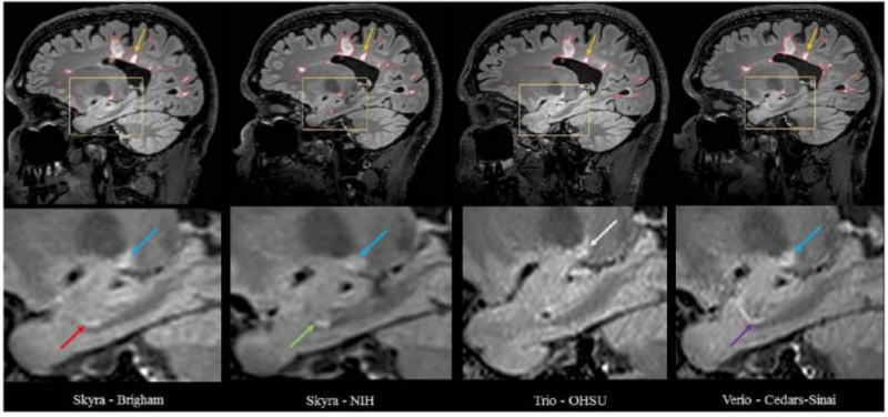 Series of brain scans