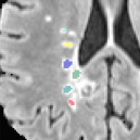 Brain scan with lesions in different colors